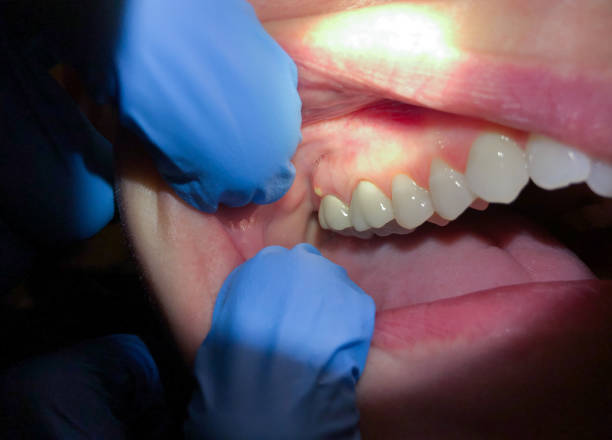 Best Dental Abscess Treatment in High Springs, FL